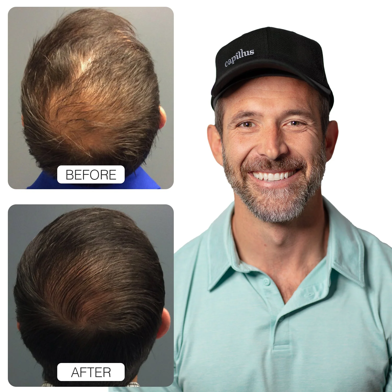 Capillus PRO - Image 3